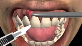 How to treat a tooth abscess [upl. by Inasah]