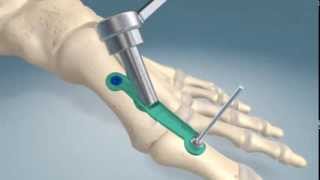 1st metatarsalphalangel joint fusion procedure [upl. by Niarb]