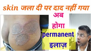 Fungal infection permanent treatment I Daad ka ilaj l Skin Care Clinic l Dr ANIL MOHITE l MD [upl. by Aniteb]