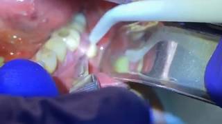 Draining a Dental Abscess  Advanced Dental Care [upl. by Griseldis]