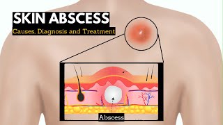 Skin Abscess Causes Signs and Symptoms Diagnosis and Treatment [upl. by Desdee]