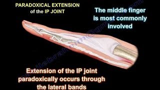 Lumbrical Plus Finger  Everything You Need To Know  Dr Nabil Ebraheim [upl. by Bartolomeo863]