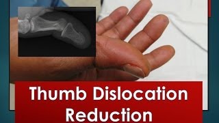 Thumb Dislocation Reduction [upl. by Louisa254]