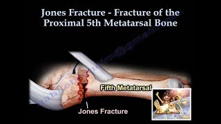 Jones Fracture  Everything You Need To Know  Dr Nabil Ebraheim [upl. by Reteid854]