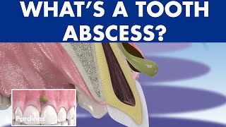 TOOTH ABSCESS dental infection  PHLEGMON symptoms and treatment © [upl. by Spector]