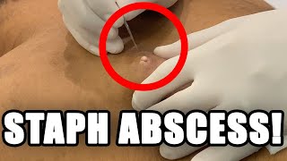 STAPH ABSCESS 🦠 [upl. by Morganica218]