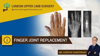 Finger joint replacement [upl. by Salbu]