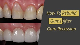 Gum Recession Cure  How to Rebuild Gums [upl. by Hazrit]