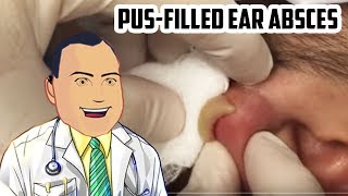 PusFilled Ear Abscess Drained  Revisited Popping [upl. by Elatsyrc]