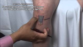 Knee Injection  Anterior Approach [upl. by Urial]