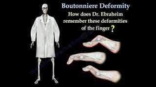 Boutonniere Deformity  Everything You Need To Know  Dr Nabil Ebraheim [upl. by Asen]