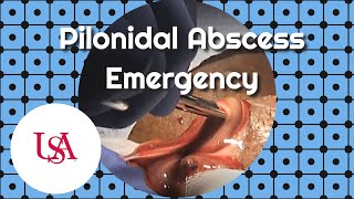 Pilonidal Abscess Emergency Incision amp Drainage [upl. by Nereus]