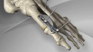 First Metatarsophalangeal Joint Fusion with Arthrex® MTP Fusion Plate [upl. by Xilef]