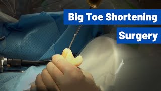 Big Toe Shortening Surgery  Hallux IP Joint Fusion [upl. by Eanal907]